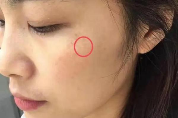 如何判断痣相斑的吉凶与健康风险