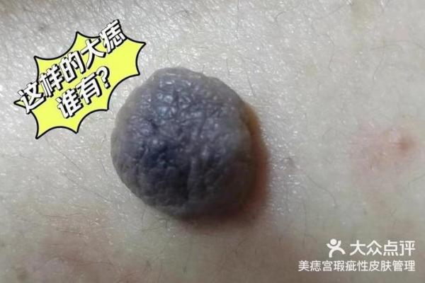 肉痣痣相学：揭示你的未来走向