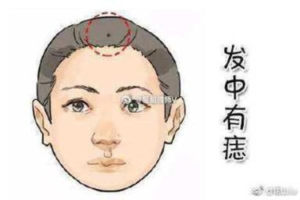 头顶痣相分析：是否代表着特别的命格