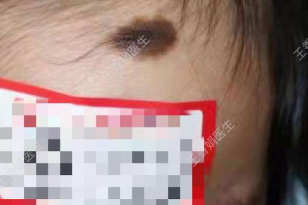 头顶痣的位置与性格特征的关联