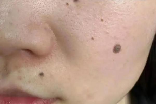 从相学角度看去痣后的面相提升