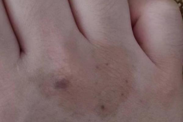 痣相斑与身体健康的关系解读