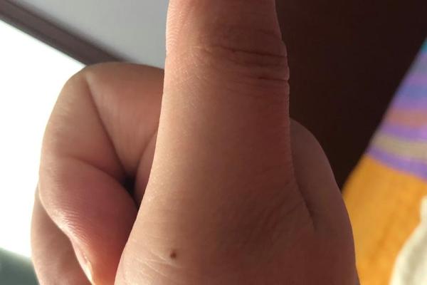 手掌中的痣：你不可忽视的命运信号