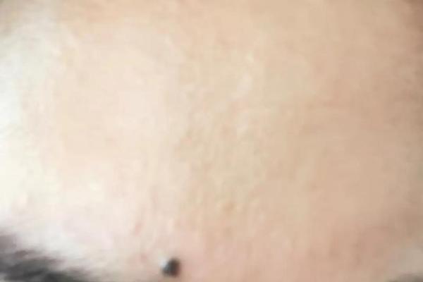 头部风水：男子左后脑勺长痣，预示着什么？