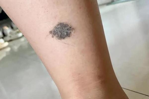 网友热议！大腿痣相预示什么？揭秘身体中的隐藏秘密！