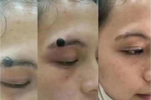 外国人如何看待痣相？一场跨文化解读之旅