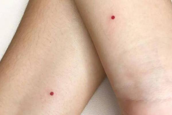 手臂关节痣，是健康信号还是美丽秘密？
