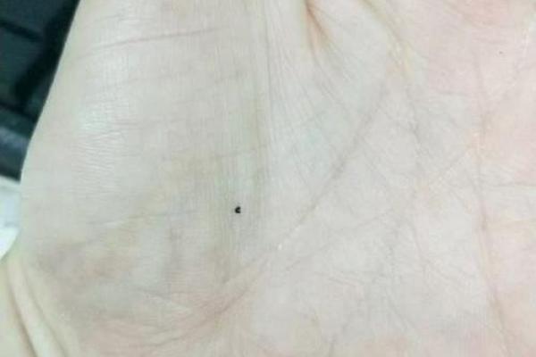 神秘脚心痣，探寻前世今生的缘分传说