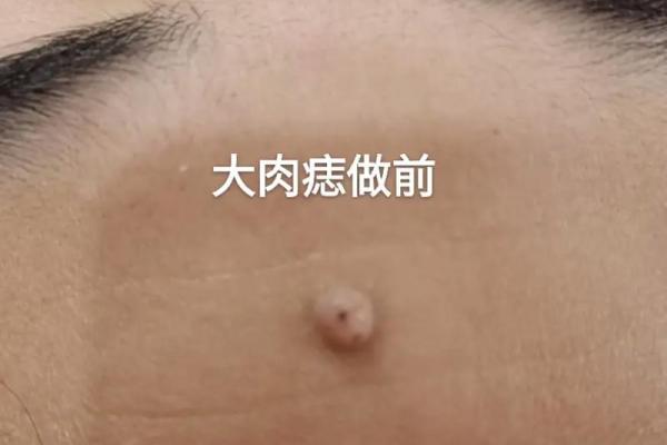痣中藏福：面中痣的神秘力量