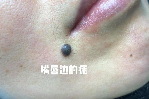 痣在嘴边，财运亨通