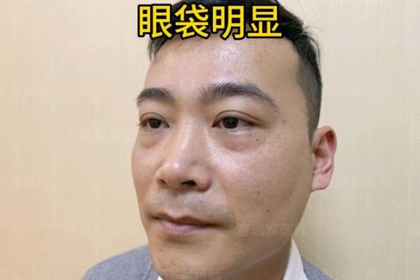 肿眼袋面相揭示：财富与健康的多面镜子