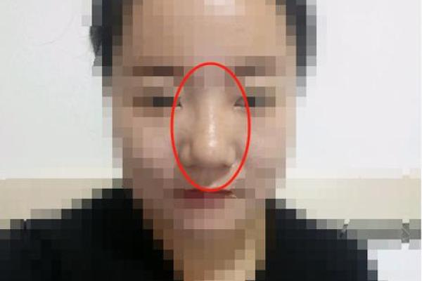 面相解析：鼻梁塌陷背后的运势影响