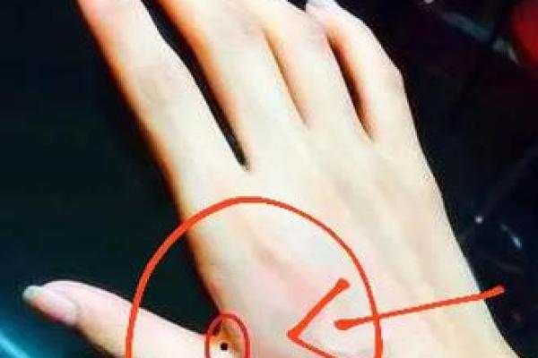 手背痣相图解：解读女性运势与性格的秘密符号