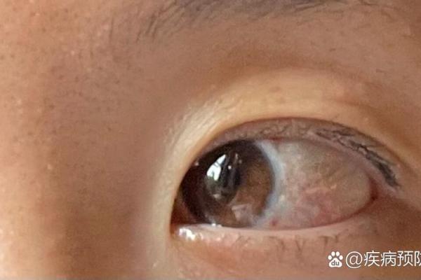 眼结膜痣，让你的眼睛瞬间变有神！