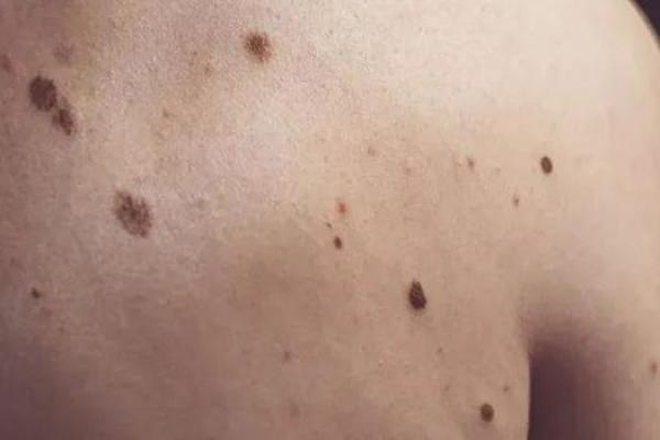 痣变奇观！腿上菊花痣，网友：羡慕嫉妒恨！