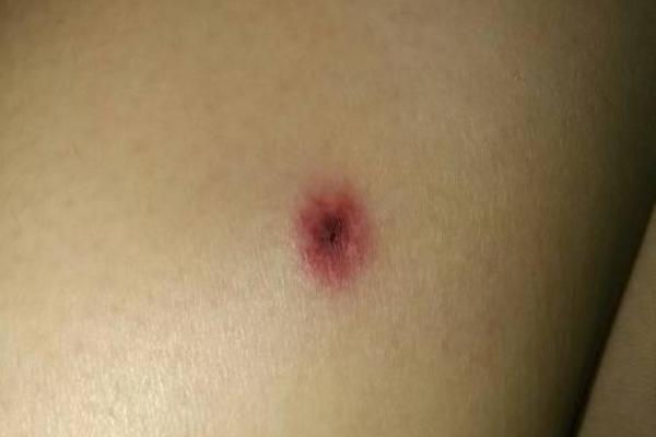 痣变奇观！腿上菊花痣，网友：羡慕嫉妒恨！