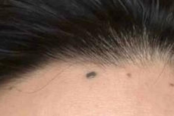 发际痣变美记：打造独特魅力
