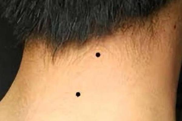 男人的颈部痣相，揭秘财运旺的秘密！
