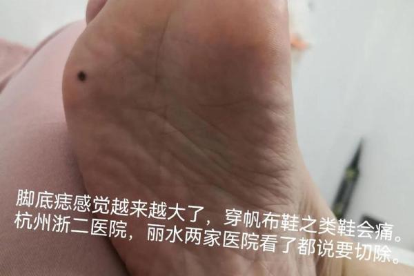 痣相脚图解大全：揭秘脚底痣的神奇含义