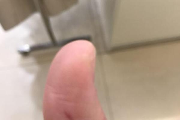 惊悚瞬间！机械伤手血肉模糊，现场触目惊心！