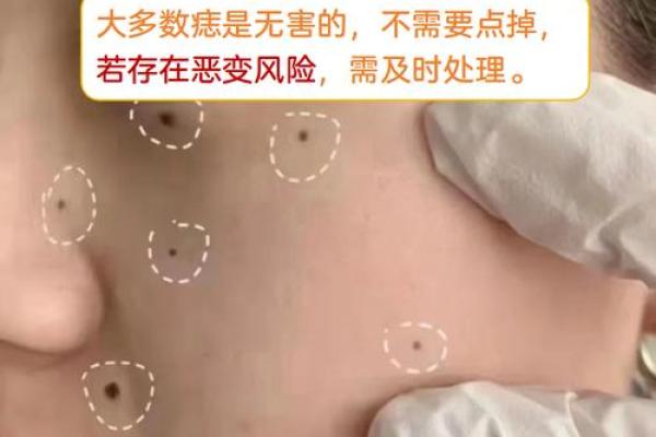 痣相暗藏破财危机？赶紧了解！