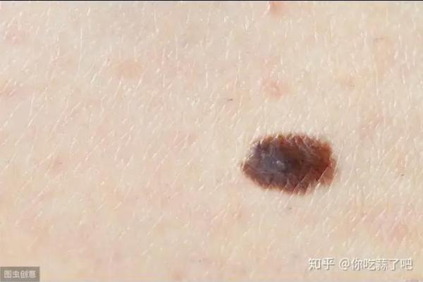 胸部痣相大揭秘：是好运还是霉运的预兆？