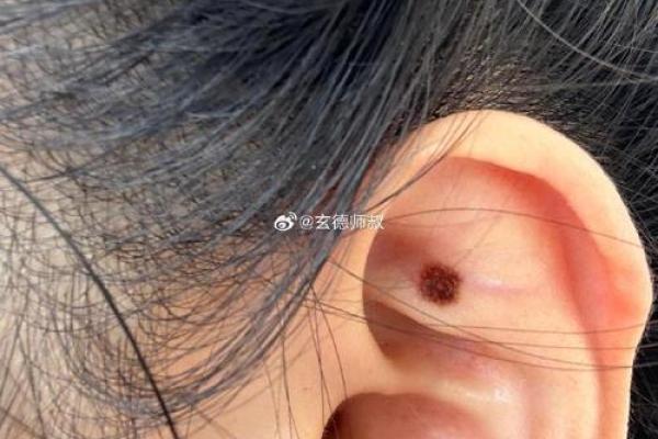 痣中藏韵：左边耳垂上的两颗痣，她的神秘符号