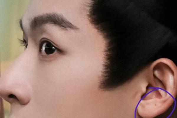耳朵屏间切迹痣，预示着什么？