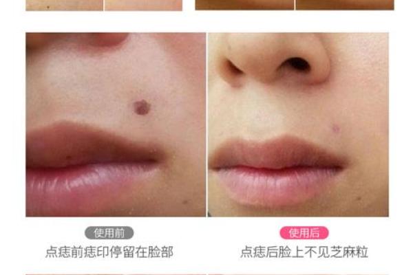 颈窝痣痣，美丽加分神器