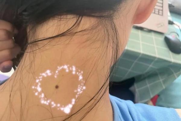 痣相与饮食习惯：少食的秘密，你猜到了吗？