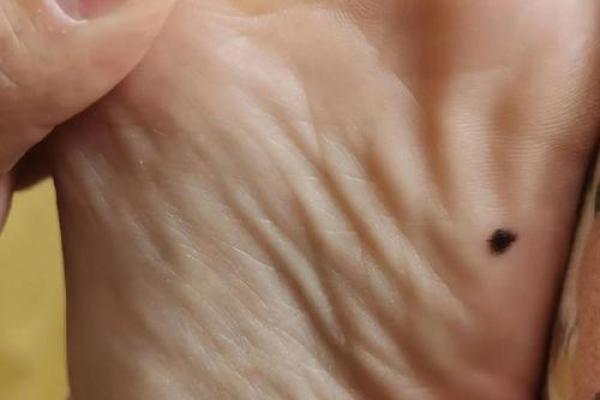 脚底至大腿，神秘痣相全解析，你的命运如何？